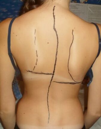 RIB Hump